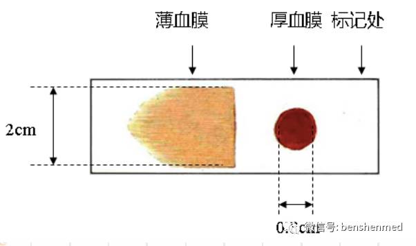 疟原虫厚血膜