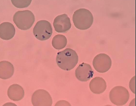 IV型网织红细胞，新亚甲蓝染色